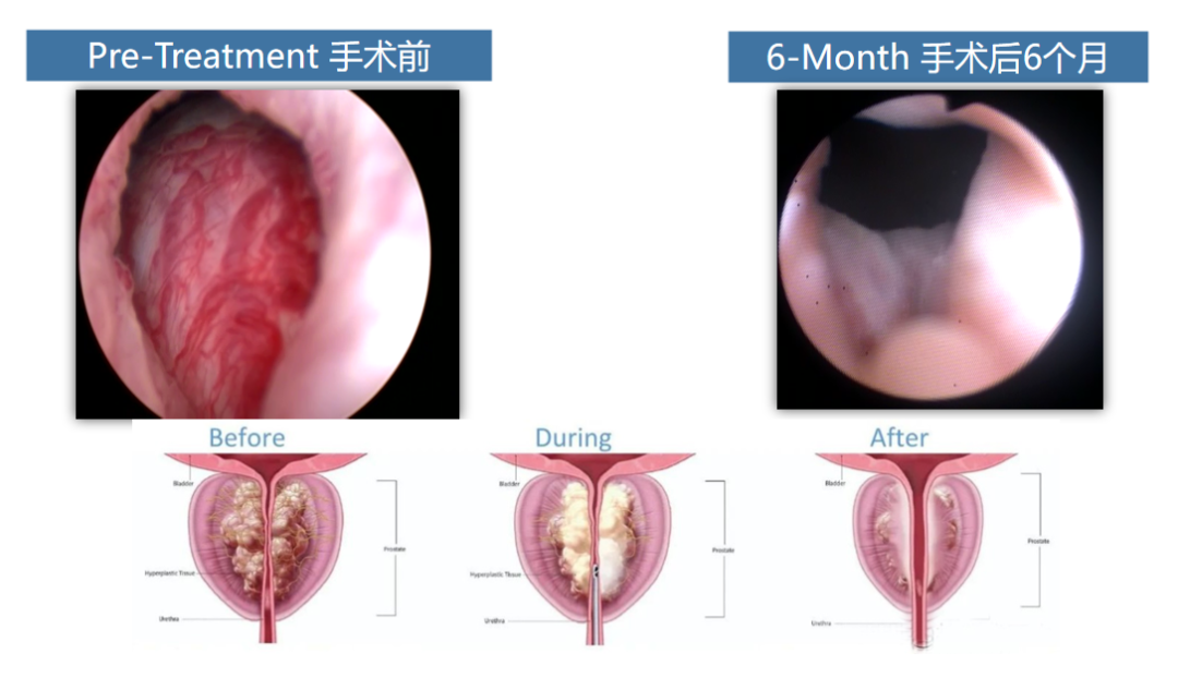 新疆来蓉：瑞梦技术6分钟，解决4年前列腺增生问题(图5)