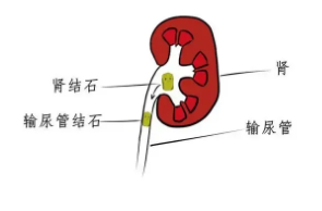 四川肾结石专科医院科普：春夏之交，如何防治肾结石“突袭”？(图6)