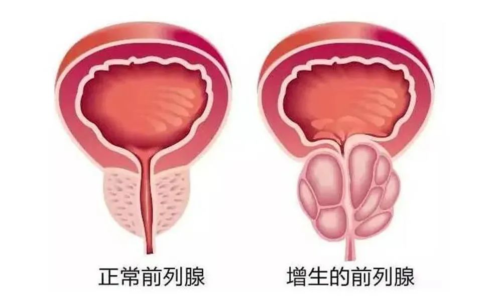 四川瑞梦热蒸汽消融术 专业治疗患者多年的前列腺增生问题(图1)
