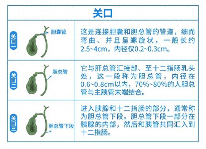 四川保胆取石医院：胆结石能否自行排出？3个危险“关口”是关键！(图1)