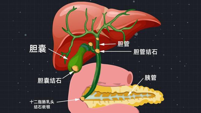 四川保胆取石医院：胆结石能否自行排出？3个危险“关口”是关键！(图3)