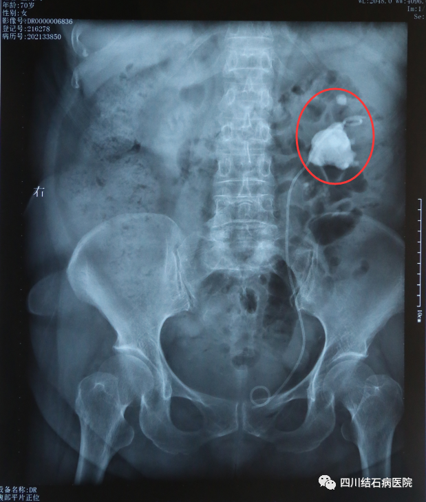 成都肾结石医院案例回顾：小小肾结石，竟险些让她患上尿毒症！(图3)