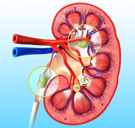 成都肾结石医院：肾结石吃药效果立竿见影？这可不能一厢情愿，还得双向奔赴！(图2)