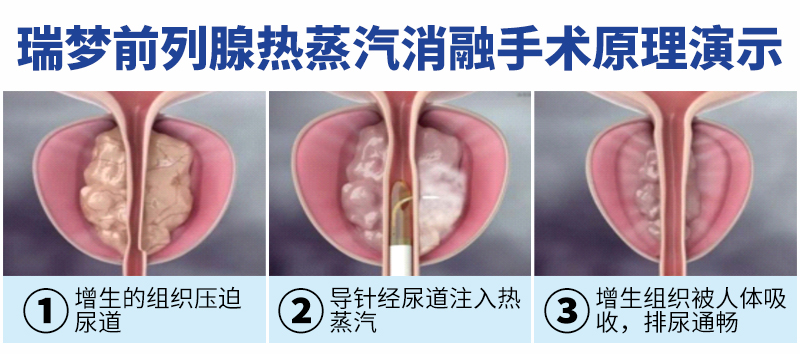 成都前列腺患者看过来！四川结石病医院瑞梦手术 5分钟解决前列腺增生！(图2)