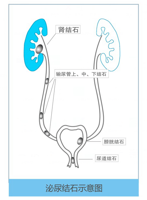 四川肾结石医院：疼痛、血尿、尿量减少？泌尿系结石发出的“红灯警告”(图2)