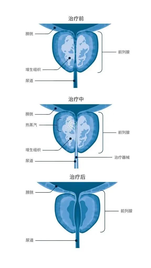 “优秀！顶尖！”103℃蒸汽，10分钟搞定十余年前列腺增生(图3)