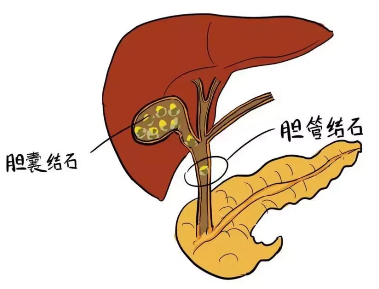 胆囊切除后有哪些影响？四川胆结石医院揭秘胆囊切除的真相！(图4)