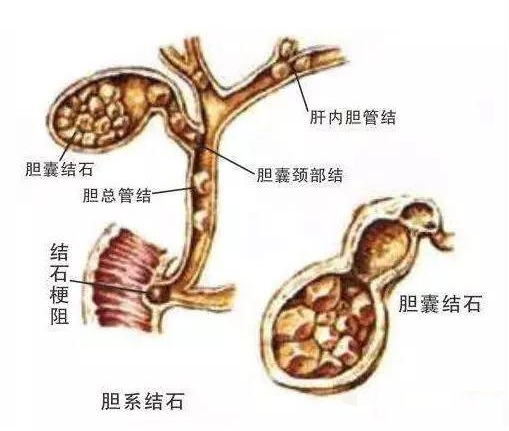 四川胆结石患者注意！胆结石出现这4种情况，必须要立即手术！(图2)