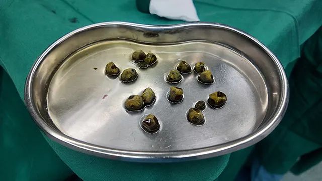 胆结石防治别踩坑!肝胆外科何明刚主任深度解析4大认知误区【四川胆结石专科医院】(图4) 胆结石防治别踩坑!肝胆外科何明刚主任深度解析4大认知误区【四川胆结石专科医院】(图4)