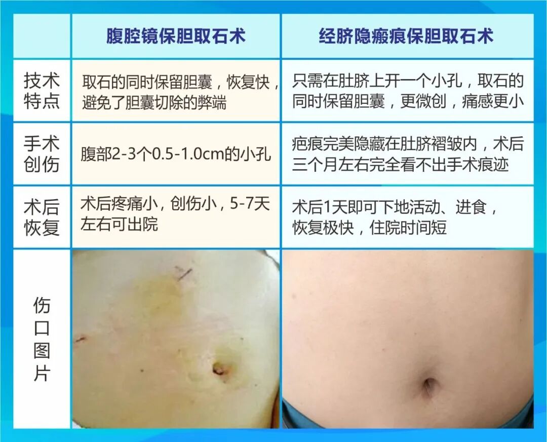 从肚脐解除胆结石困扰：经脐隐瘢痕技术助患者重塑健康与自信【四川结石病医院】(图3)