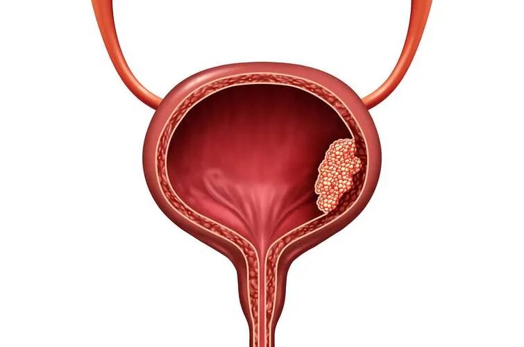 身体在报警！排尿异常背后的“真凶”，可能是膀胱结石【四川结石病专科医院】(图4)