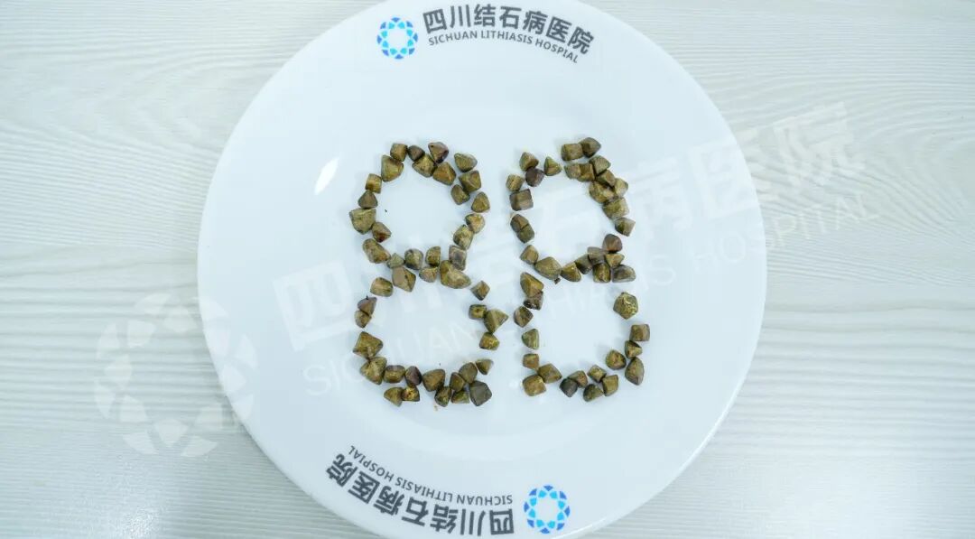 88颗结石“鸠占鹊巢”？四川结石病医院经脐超微创一招取出(图1)