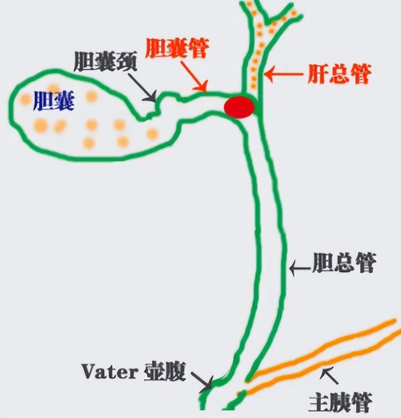 胆囊结石为啥一碰油腻就发作？出现这种情况该怎么办？【四川结石病医院】(图2)