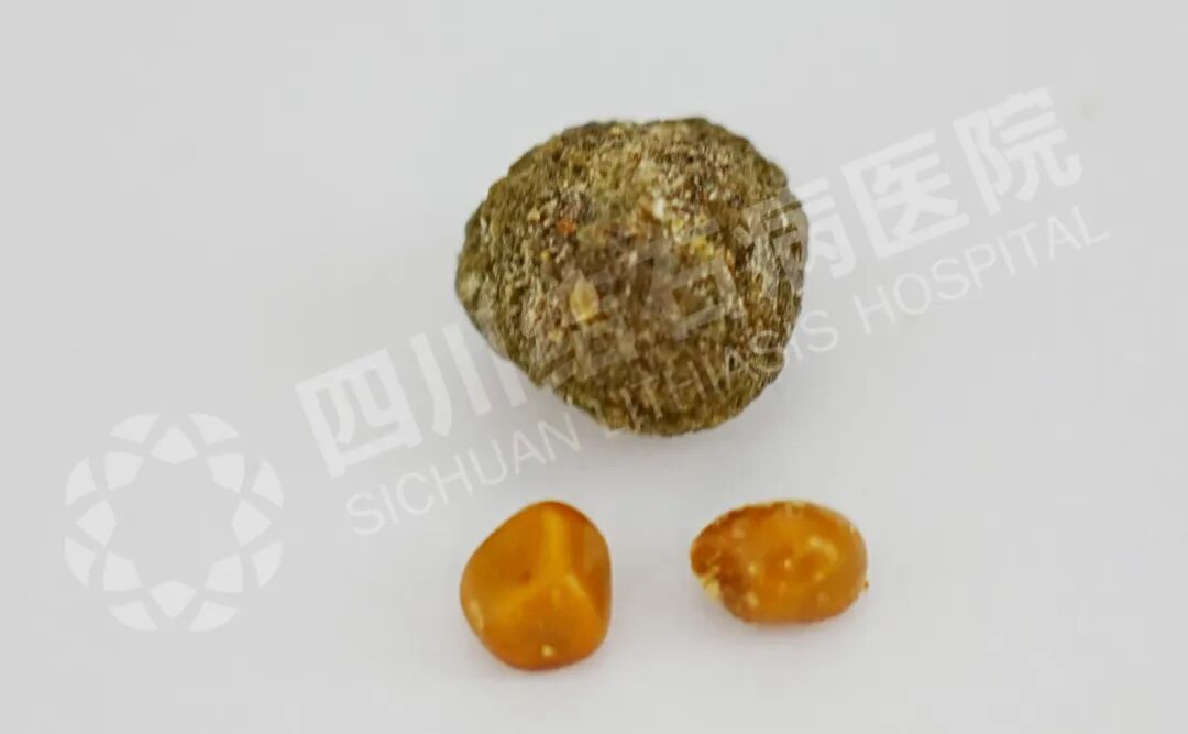 57岁老师亲历保胆，三句“一级棒”点赞！四川保胆取石医院(图1)