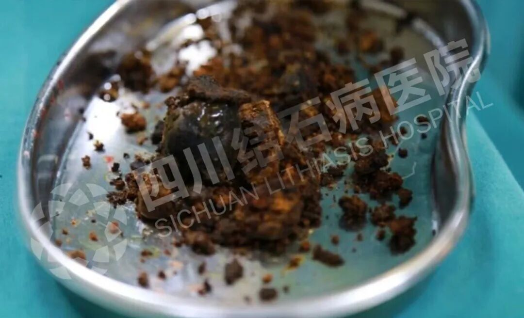 顿顿肥肉不忌口？七旬老兵体内取出鸭蛋大结石【四川结石病医院】(图2)