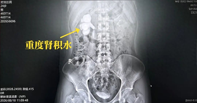 仅半年！结石发作“忍一忍”，一查肾脏差点“报废”？【四川结石病医院】(图1)