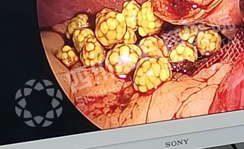 四川结石病医院提醒:胆囊内惊现“爆米花”!这些习惯你可能也有(图3) 四川结石病医院提醒:胆囊内惊现“爆米花”!这些习惯你可能也有(图3)