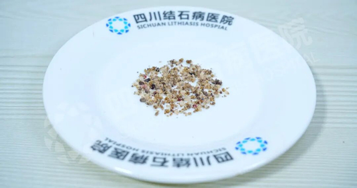 结石患者发出疑问：平时毫无感觉，为何泌尿结石一疼就“要命”？【四川结石病医院】(图2)